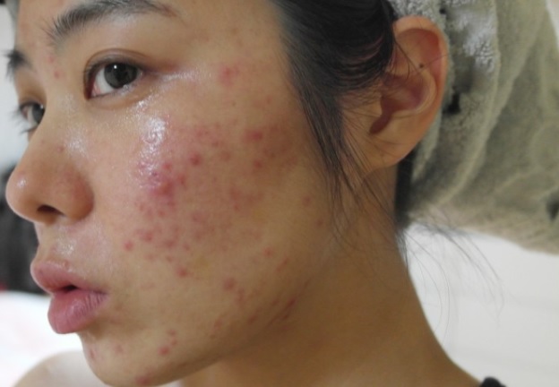 繰り返しできるニキビにストップを 薬用ニキビ専用洗顔石鹸を試したら凄すぎた